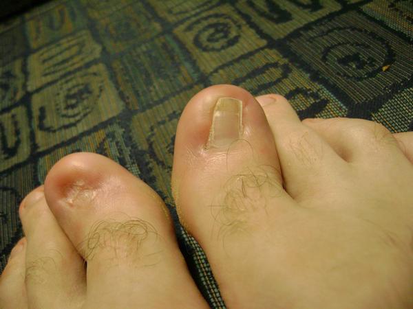 toes ugly